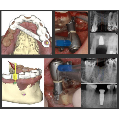 Guided Surgery Course in Chicago Kit and  Course  Hotel Package 13th December 2025